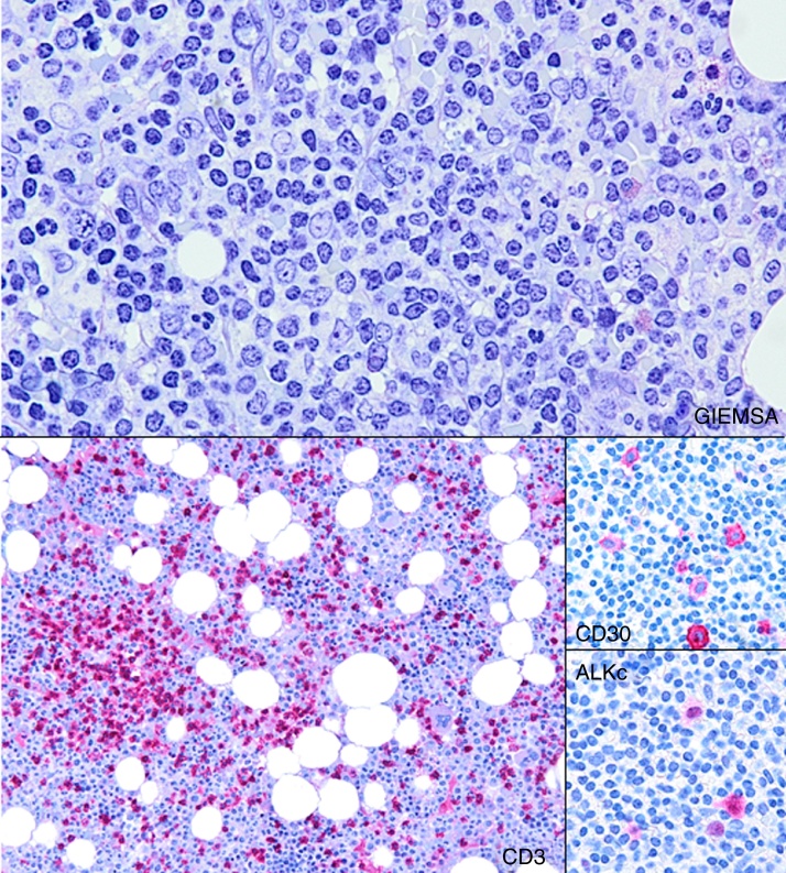 Small cell variant of anaplastic large cell lymphoma with leukemic presentation: a diagnostic challenge