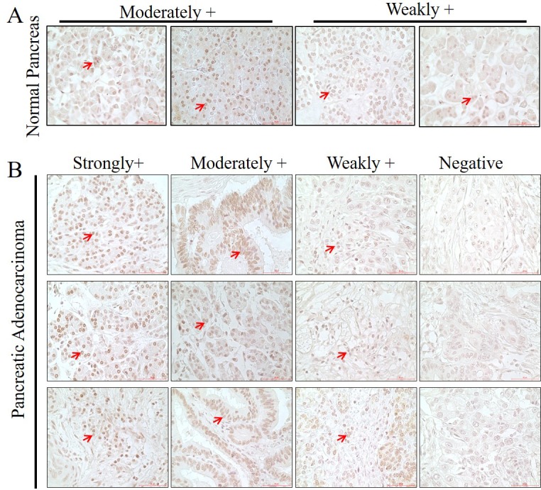 Pathological and prognostic role of mdig in pancreatic cancer.