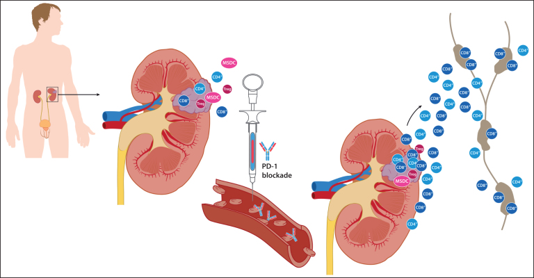 Transforming the Perioperative Treatment Paradigm in Non-Metastatic RCC-A Possible Path Forward.