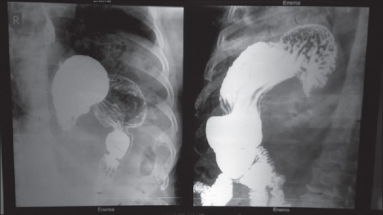 Subacute Gastric Volvulus: A Report of Two Cases with Review of Literature.