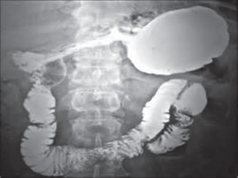 Subacute Gastric Volvulus: A Report of Two Cases with Review of Literature.