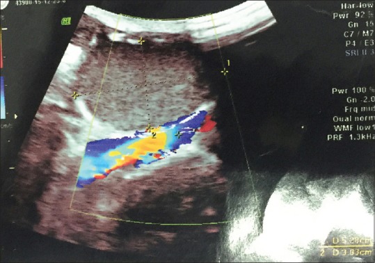 Epidermoid Cyst in Inguinal Canal: A Rare Presentation.
