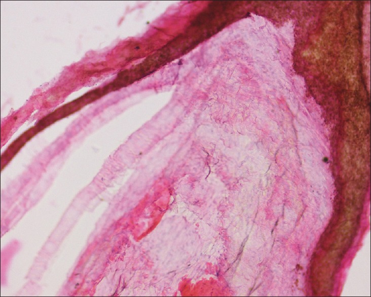 Epidermoid Cyst in Inguinal Canal: A Rare Presentation.