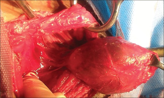 Epidermoid Cyst in Inguinal Canal: A Rare Presentation.
