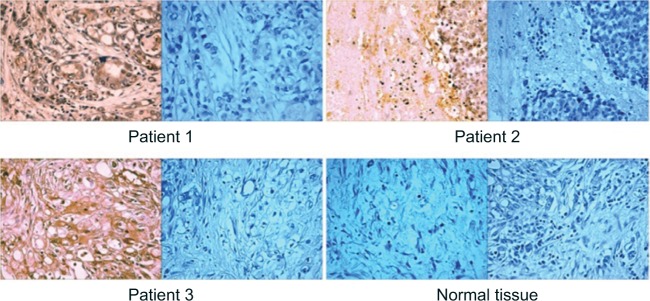 NMDA receptors are important regulators of pancreatic cancer and are potential targets for treatment.