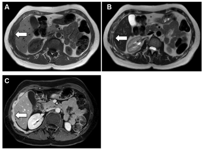 Clinical staging of malignant pleural mesothelioma: current perspectives.