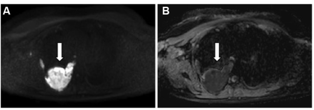 Clinical staging of malignant pleural mesothelioma: current perspectives.