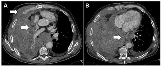Clinical staging of malignant pleural mesothelioma: current perspectives.