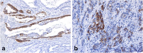 Differential expression of CK20, β-catenin, and MUC2/5AC/6 in Lynch syndrome and familial colorectal cancer type X.