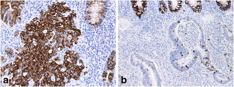 Differential expression of CK20, β-catenin, and MUC2/5AC/6 in Lynch syndrome and familial colorectal cancer type X.