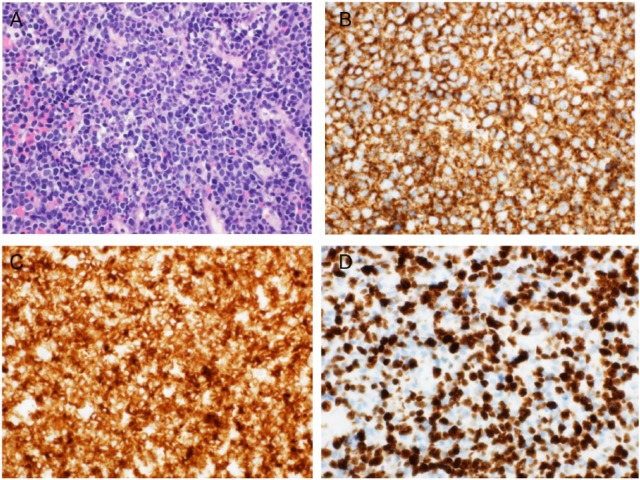 Diffuse Large B-Cell Breast Lymphoma: A Case Series.