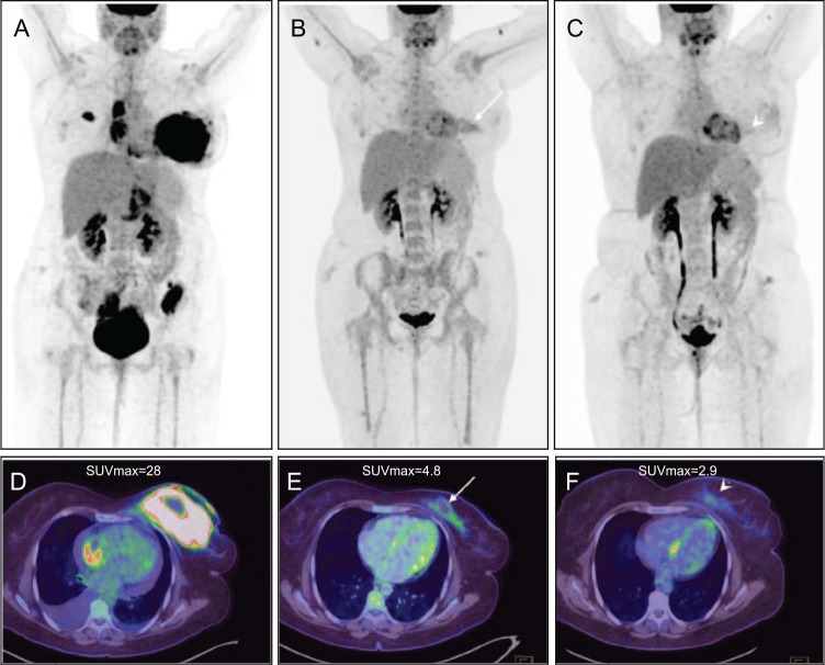 Diffuse Large B-Cell Breast Lymphoma: A Case Series.