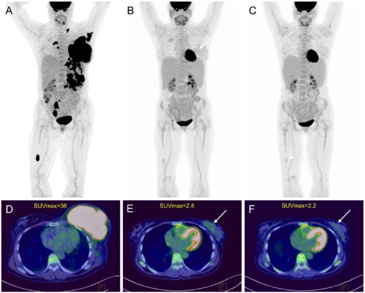 Diffuse Large B-Cell Breast Lymphoma: A Case Series.