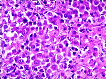 Malignant Deciduoid Mesothelioma: case presentation of an exceptional variant and review of the literature.