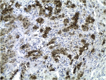 Malignant Deciduoid Mesothelioma: case presentation of an exceptional variant and review of the literature.