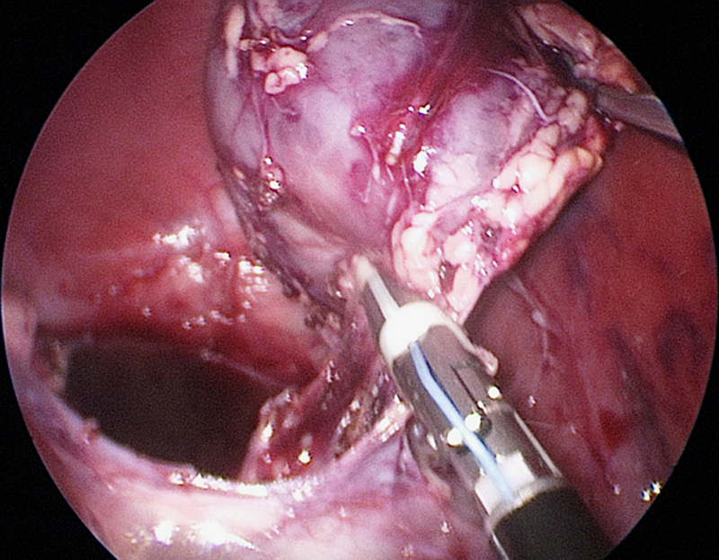 Pediatric oncologic endosurgery.