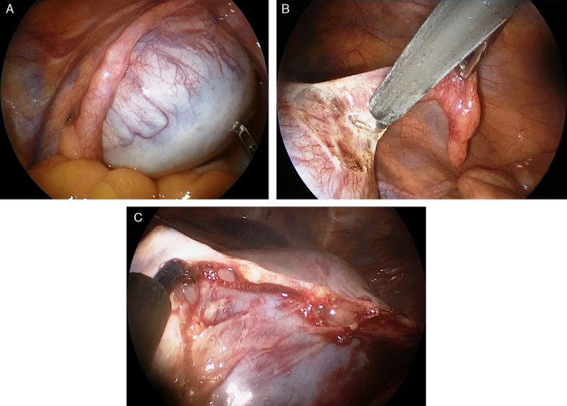 Pediatric oncologic endosurgery.