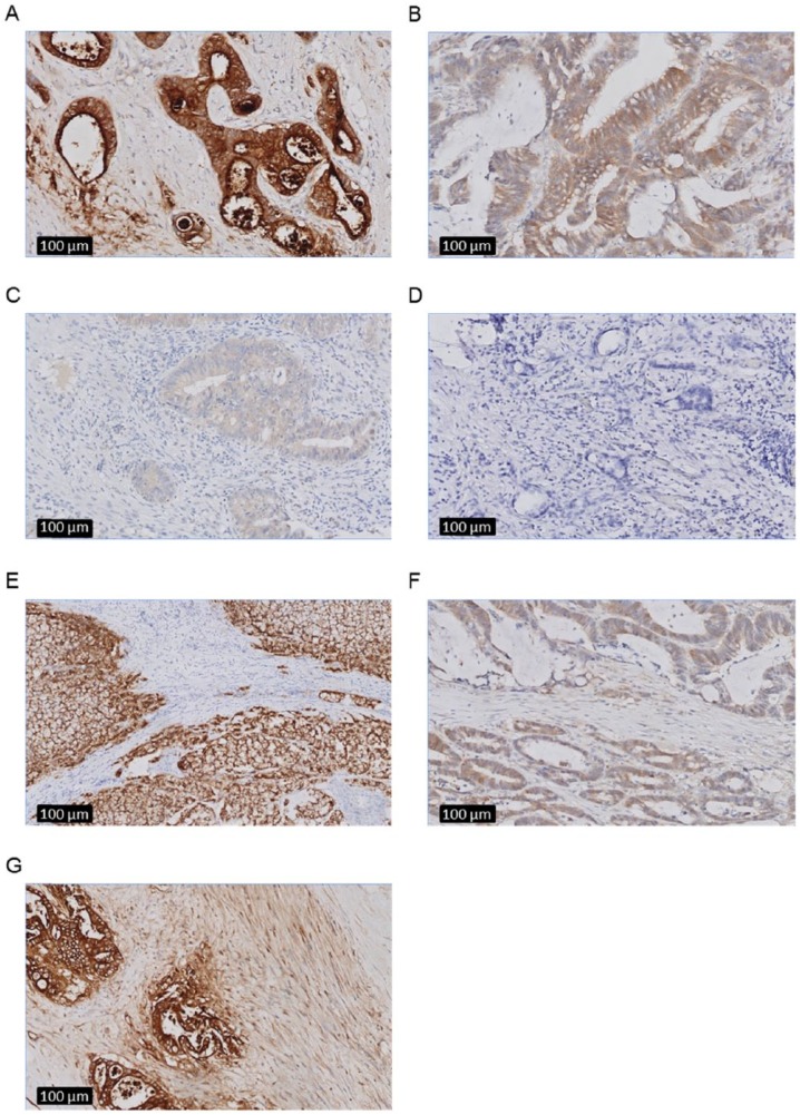 In Search for Optimal Targets for Intraoperative Fluorescence Imaging of Peritoneal Metastasis From Colorectal Cancer.