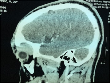 Inflammatory myofibroblastic tumor of the lacrimal gland: case report of an exceptional location.