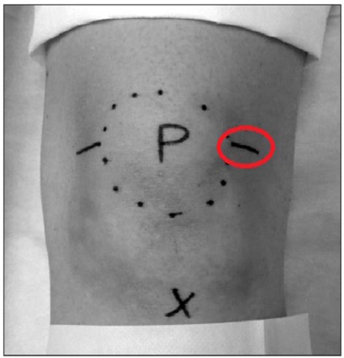 Comparison of the 3 Different Injection Techniques Used in a Randomized Controlled Study Evaluating a Cross-Linked Sodium Hyaluronate Combined With Triamcinolone Hexacetonide (Cingal) for Osteoarthritis of the Knee: A Subgroup Analysis.