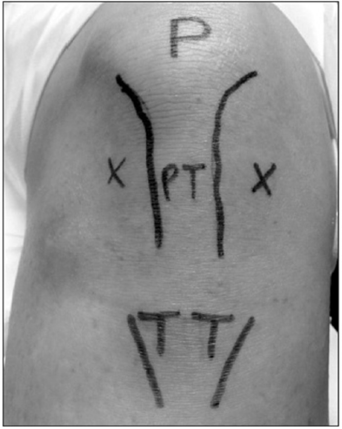 Comparison of the 3 Different Injection Techniques Used in a Randomized Controlled Study Evaluating a Cross-Linked Sodium Hyaluronate Combined With Triamcinolone Hexacetonide (Cingal) for Osteoarthritis of the Knee: A Subgroup Analysis.