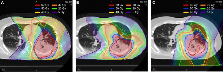 Proton beam therapy in non-small cell lung cancer: state of the art.