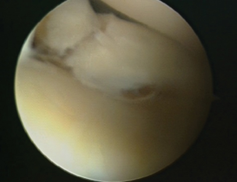 Relationship between Clinical, MRI, and Arthroscopic Findings: A Guide to Correct Diagnosis of Meniscal Tears.