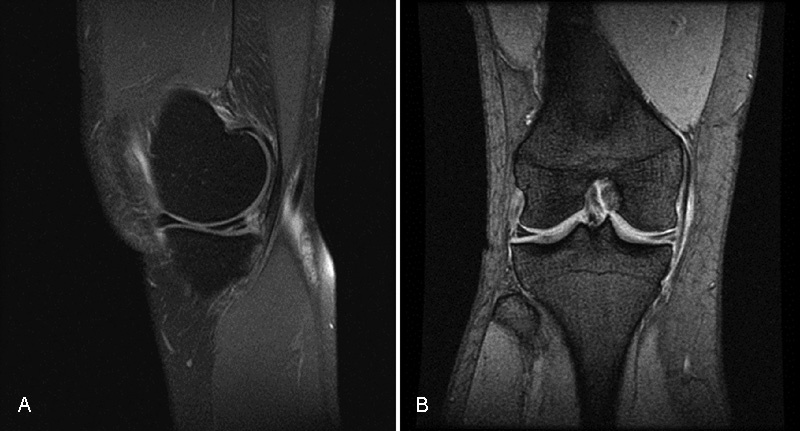 Relationship between Clinical, MRI, and Arthroscopic Findings: A Guide to Correct Diagnosis of Meniscal Tears.