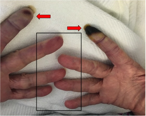 Digital Ischemia and Necrosis: A Rarely Described Complication of Gemcitabine in Pancreatic Adenocarcinoma.