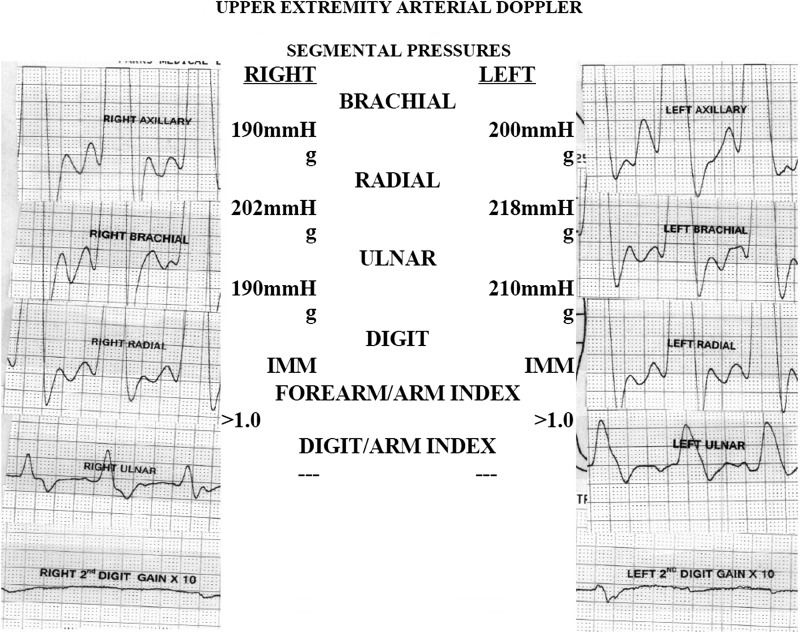 Digital Ischemia and Necrosis: A Rarely Described Complication of Gemcitabine in Pancreatic Adenocarcinoma.