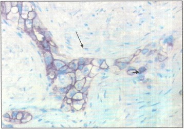 Primary ovarian angiosarcoma in a 12- year -old girl: a case report of an exceptional localization in a context of limited resources country.