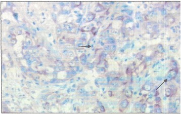 Primary ovarian angiosarcoma in a 12- year -old girl: a case report of an exceptional localization in a context of limited resources country.