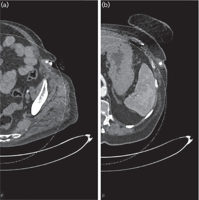 <i>Salmonella</i> Typhimurium gastroenteritis leading to chronic prosthetic vascular graft infection.