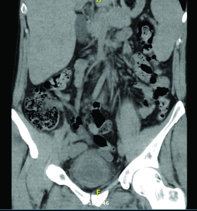 <i>Salmonella</i> Oranienburg haemorrhagic cystitis in an immunocompetent young male.