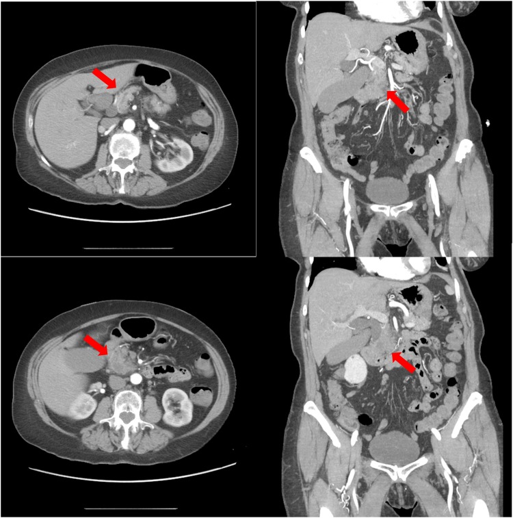 Perioperative Management of Factor V Leiden and Pancreatic Adenocarcinoma.