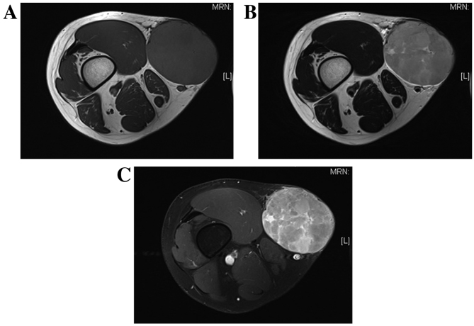 Detailed analysis of a superficial CD34-positive fibroblastic tumor: A case report and review of the literature.