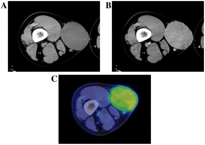 Detailed analysis of a superficial CD34-positive fibroblastic tumor: A case report and review of the literature.