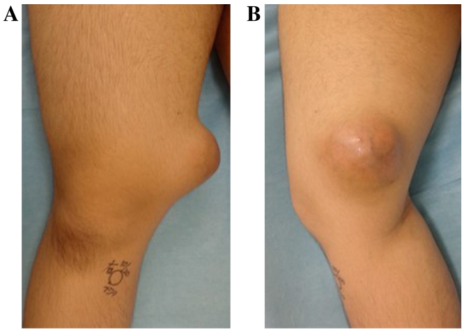 Detailed analysis of a superficial CD34-positive fibroblastic tumor: A case report and review of the literature.