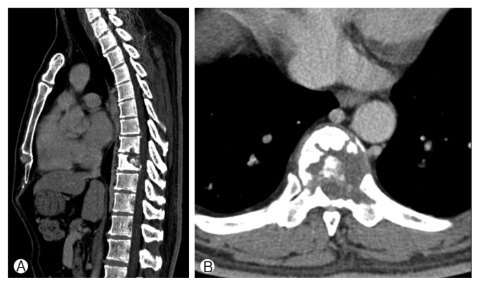 Langerhans Cell Histiocytosis of the Thoracic Spine in an Adult.