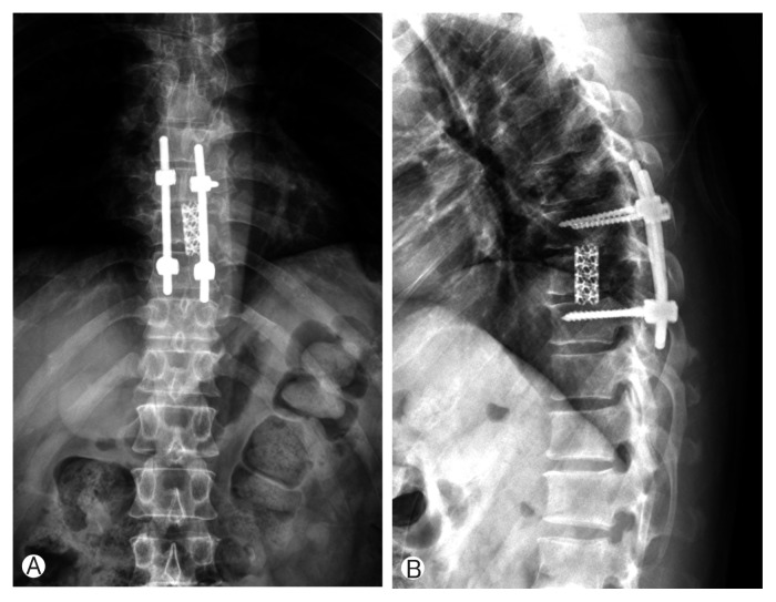 Langerhans Cell Histiocytosis of the Thoracic Spine in an Adult.