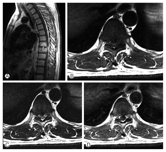 Langerhans Cell Histiocytosis of the Thoracic Spine in an Adult.