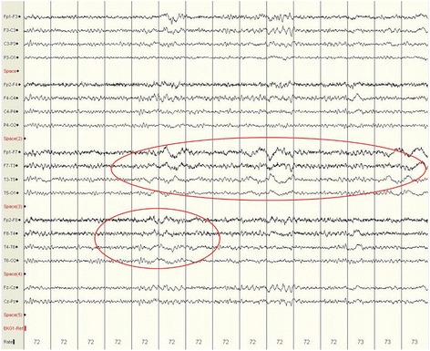 Are we missing non-motor seizures in Parkinson's disease? Two case reports.