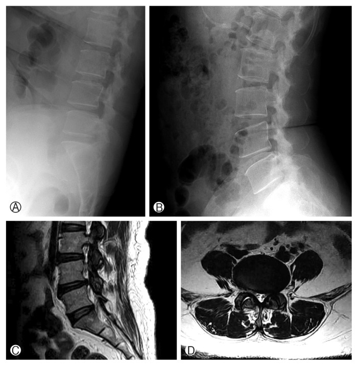 Hemorrhagic Lumbar Synovial Cyst after Microscopic Discectomy.