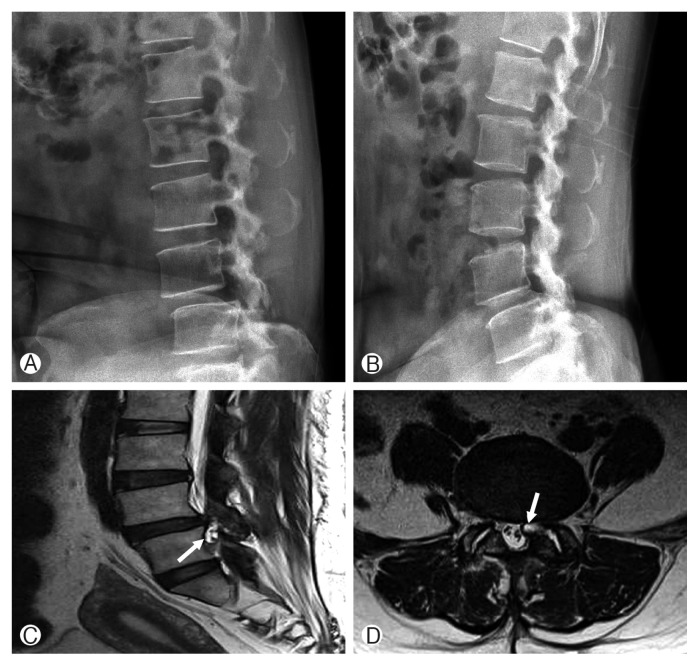 Hemorrhagic Lumbar Synovial Cyst after Microscopic Discectomy.