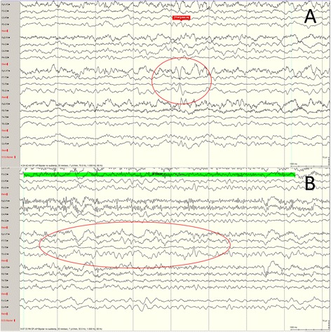 Are we missing non-motor seizures in Parkinson's disease? Two case reports.