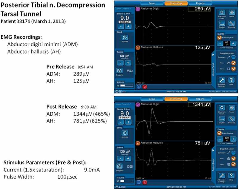 Nerve decompression and neuropathy complications in diabetes: Are attitudes discordant with evidence?