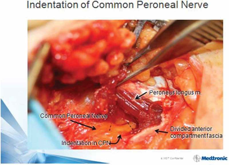 Nerve decompression and neuropathy complications in diabetes: Are attitudes discordant with evidence?