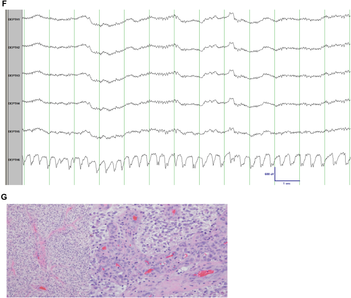 Paroxysmal dysphasia in a 68 year-old man: Enhancing the MRI spectrum!