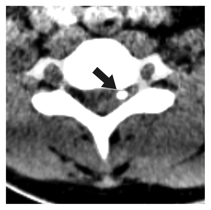 Spontaneous Epidural Hematoma Associated with Venous Phlebolith in Cervical Spine and Possible Pathogenesis.