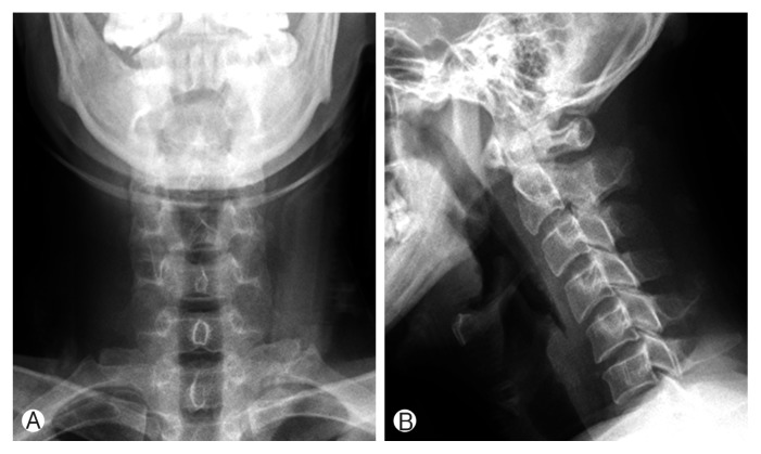 Spontaneous Epidural Hematoma Associated with Venous Phlebolith in Cervical Spine and Possible Pathogenesis.